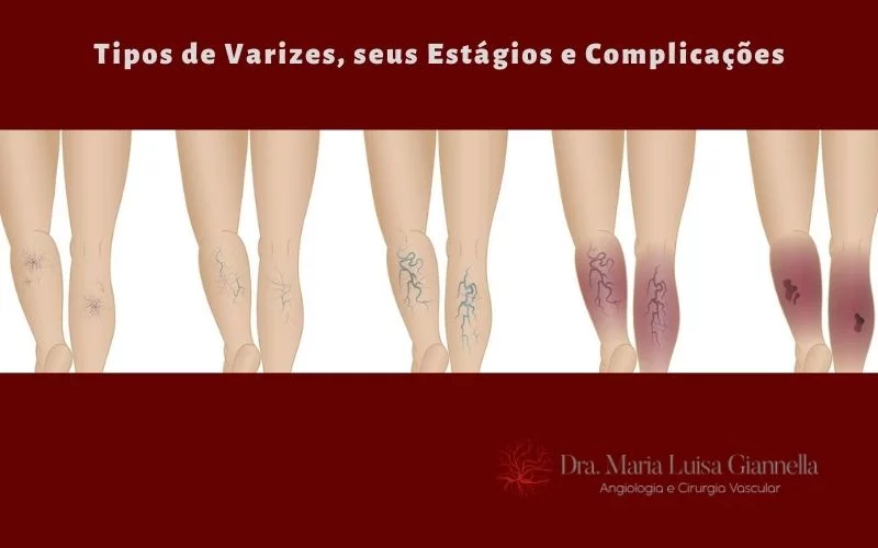 Varizes Pernas Varizes | Causas, Graus, Sintomas E Tratamento