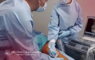 Cirurgia de Varizes com Anestesia Local