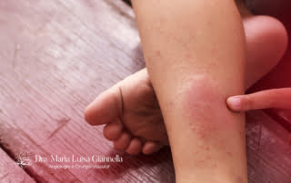 Como Tratar a Dermatite de Estase