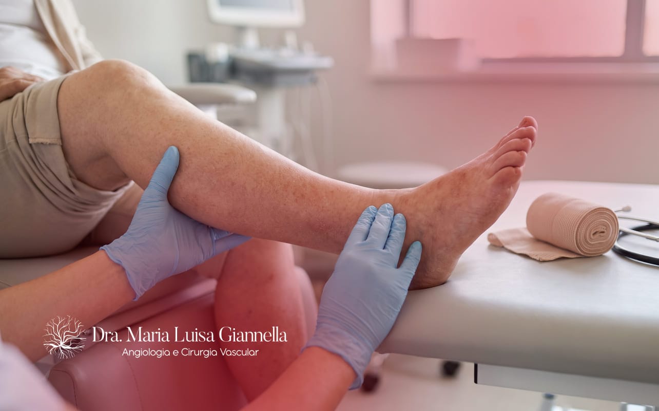 Dermatite de Estase