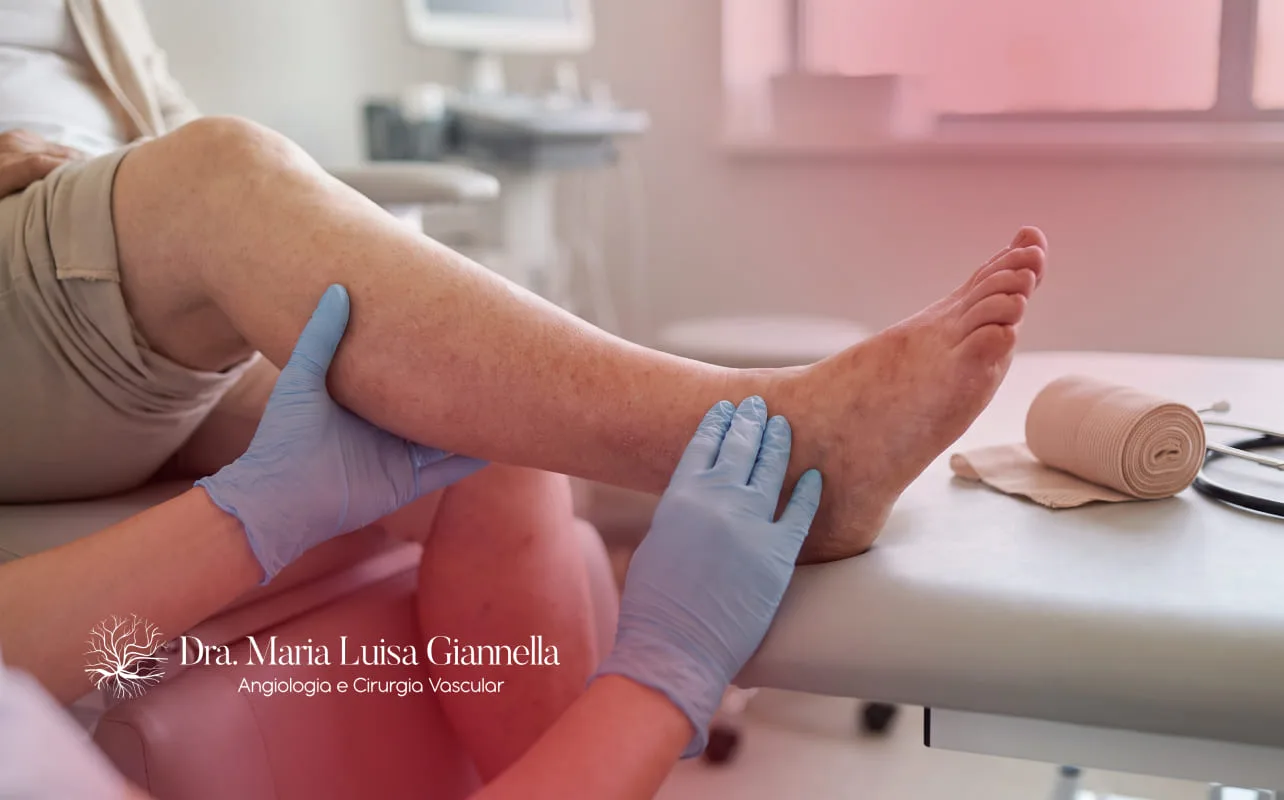 Dermatite de Estase
