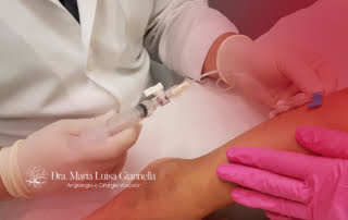 Escleroterapia com Espuma