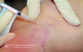 Escleroterapia com Glicose