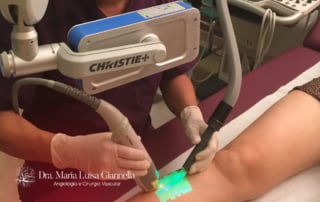 CLaCs para Tratamento de Varizes