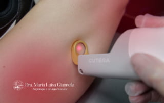 Remoção de Varizes com Laser