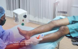 Tratamento de Varizes nos Homens