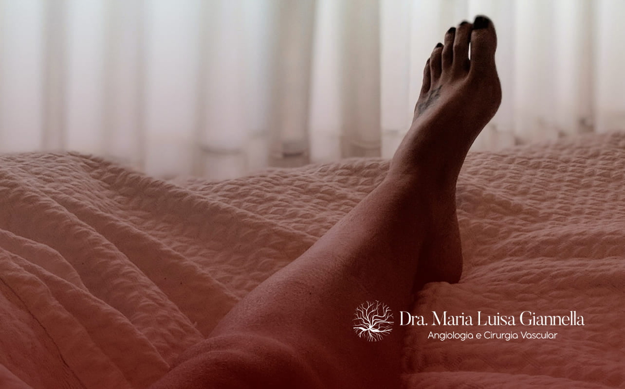 Tromboflebite Superficial - Causas, Sintomas e Tratamento