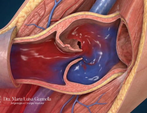 Refluxo Valvular: Entenda Porque as Válvulas das Veias Param de Funcionar